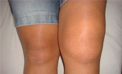 Las causas de la osteoartritis de la articulación de la rodilla