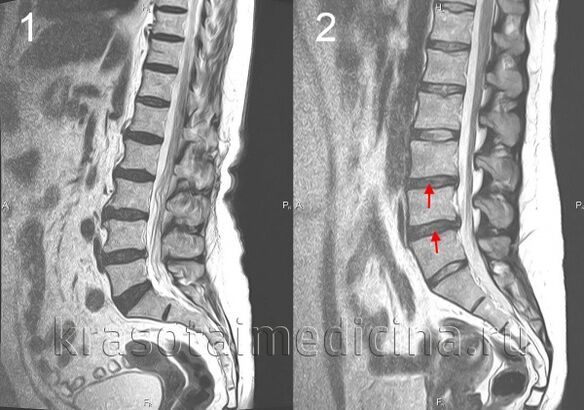Osteocondrosis de la columna