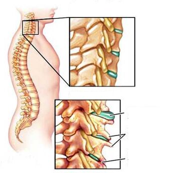 Comparación de una vértebra sana y enferma en el cuello