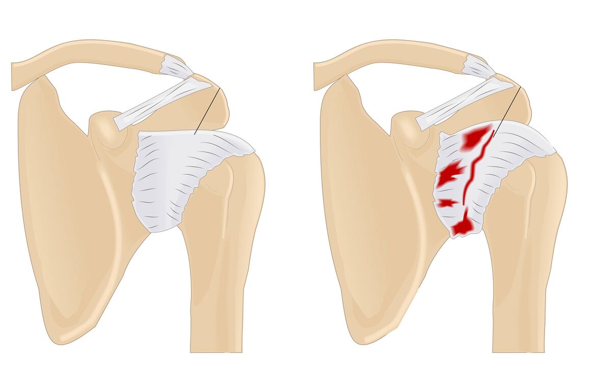 articulación normal y afectada